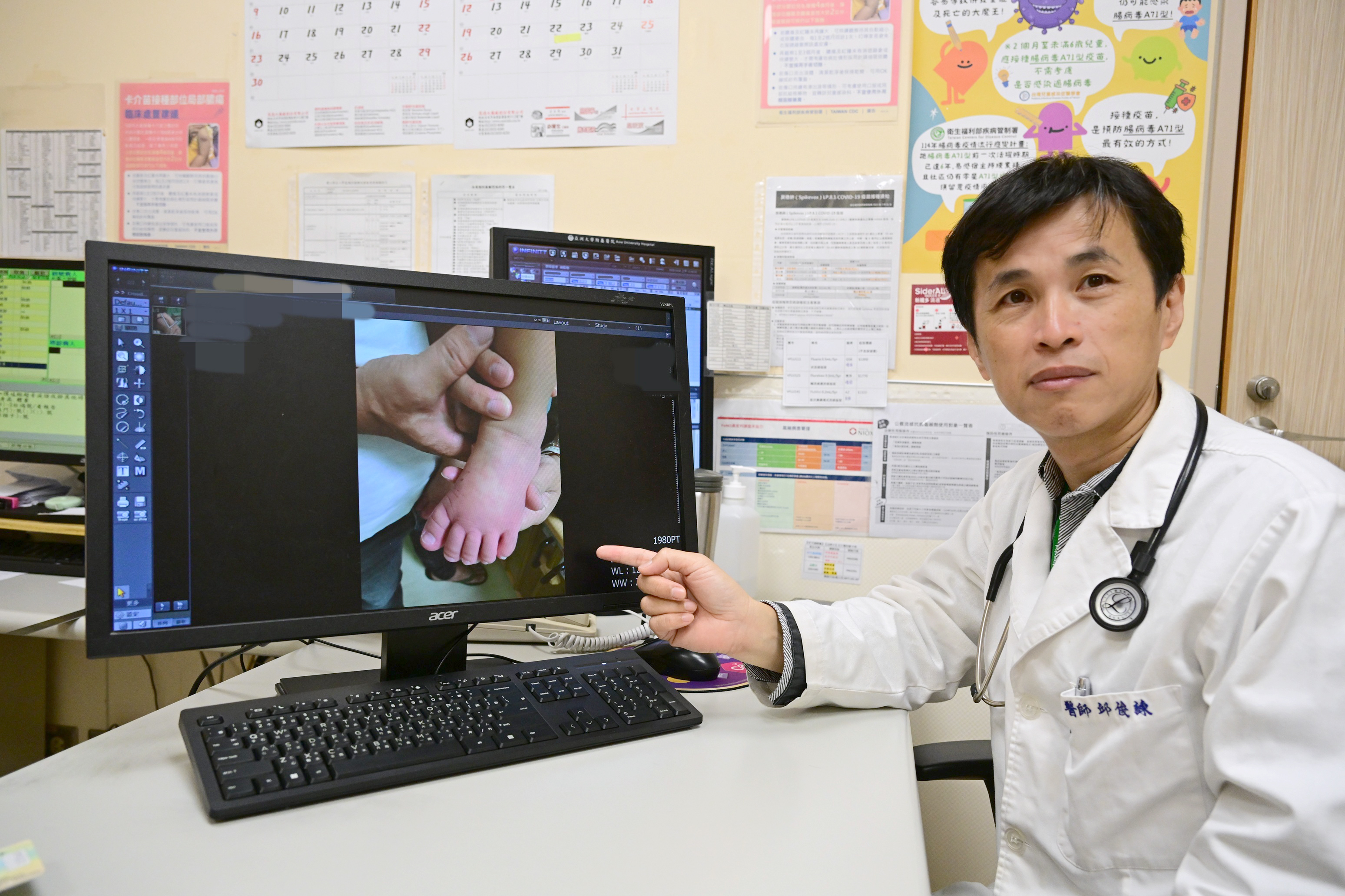 2歲童燒不停 血輪眼、手腳「腫得像麵龜」 原來是川崎症惹的禍