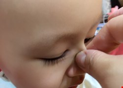 常捏寶寶鼻樑可使鼻子高挺　醫斥：小心鼻腔受感染