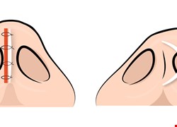 粉領族長期鼻塞、喉嚨乾 「結構式鼻整形」大幅改善鼻中膈彎曲