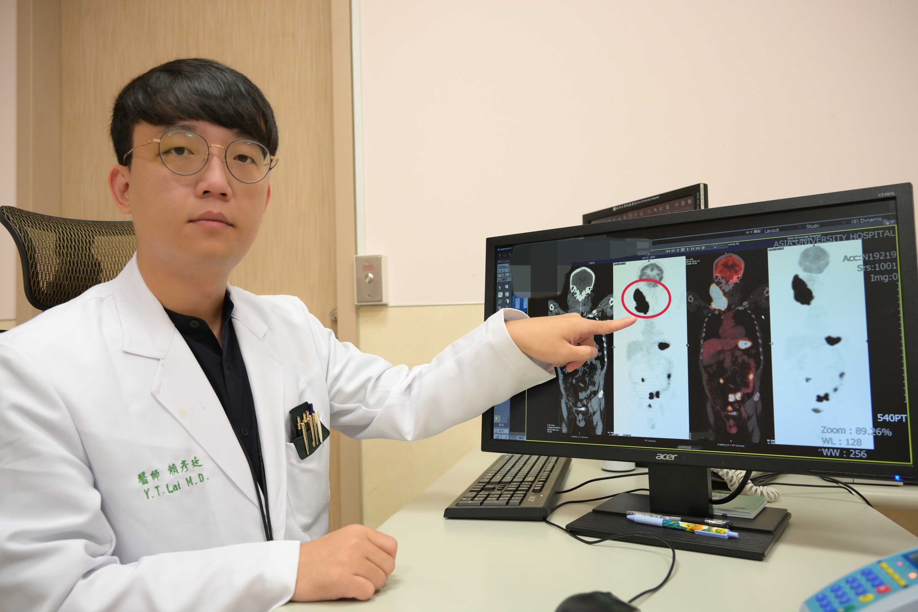 老翁頸部長出「鴕鳥蛋」壓迫氣管險致命 竟是伯基特淋巴瘤惹的禍