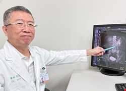 手搖飲當水喝結石引發腎水腫 廚師「痛到腿軟」 震波碎石助復原